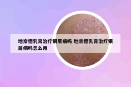 地奈德乳膏治疗银屑病吗 地奈德乳膏治疗银屑病吗怎么用