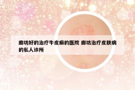 廊坊好的治疗牛皮癣的医院 廊坊治疗皮肤病的私人诊所