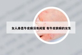 女人身患牛皮癣没有闺蜜 有牛皮肤癣的女生