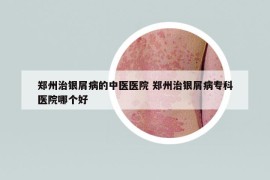 郑州治银屑病的中医医院 郑州治银屑病专科医院哪个好