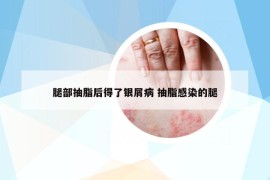 腿部抽脂后得了银屑病 抽脂感染的腿