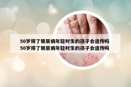 50岁得了银屑病年轻时生的孩子会遗传吗 50岁得了银屑病年轻时生的孩子会遗传吗