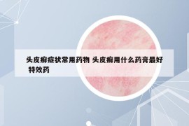 头皮癣症状常用药物 头皮癣用什么药膏最好 特效药