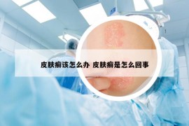 皮肤癣该怎么办 皮肤癣是怎么回事