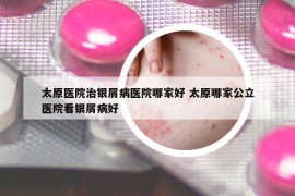 太原医院治银屑病医院哪家好 太原哪家公立医院看银屑病好