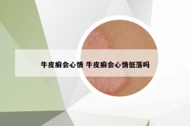 牛皮癣会心情 牛皮癣会心情低落吗