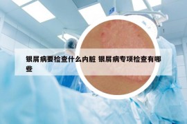 银屑病要检查什么内脏 银屑病专项检查有哪些