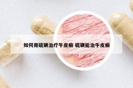 如何用硫磺治疗牛皮癣 硫磺能治牛皮癣