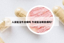 人尿能治牛皮癣吗 牛尿能治银屑病吗?