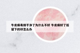 牛皮癣毒排干净了为什么不好 牛皮癣好了后留下的印怎么办