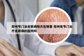 郑州专门治皮肤病地方在哪里 郑州有专门治疗皮肤病的医院吗