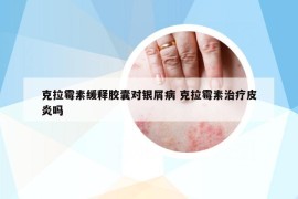 克拉霉素缓释胶囊对银屑病 克拉霉素治疗皮炎吗