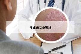 牛皮癣艾灸可以