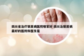 四川省治疗银屑病医院哪家好 四川治银屑病最好的医院和医生是