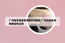 广州哪家看银屑病最好的医院 广州治银屑病哪里医院正规