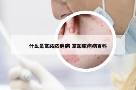 什么是掌跖脓疱病 掌跖脓疱病百科