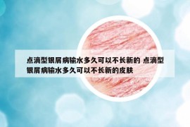 点滴型银屑病输水多久可以不长新的 点滴型银屑病输水多久可以不长新的皮肤