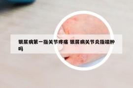 银屑病第一指关节疼痛 银屑病关节炎指端肿吗