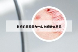 长癣的原因是为什么 长癣什么意思