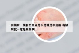 有鳞屑一挠有出血点是不是就是牛皮癣 有鳞屑就一定是银屑病