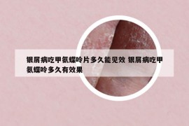 银屑病吃甲氨蝶呤片多久能见效 银屑病吃甲氨蝶呤多久有效果