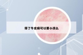 得了牛皮癣可以要小孩么