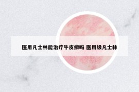 医用凡士林能治疗牛皮癣吗 医用级凡士林