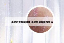 泰安对牛皮癣健康 泰安银屑病医院电话