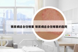 银屑病适合住哪里 银屑病适合住哪里的医院