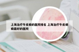 上海治疗牛皮癣的医院排名 上海治疗牛皮病癣最好的医院