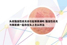 头皮脂溢性皮炎会引起银屑病吗 脂溢性皮炎与银屑病一起存在头上怎么样治