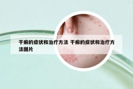干癣的症状和治疗方法 干癣的症状和治疗方法图片