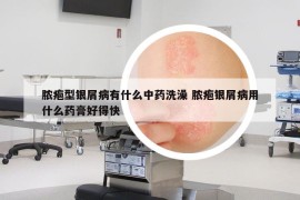脓疱型银屑病有什么中药洗澡 脓疱银屑病用什么药膏好得快