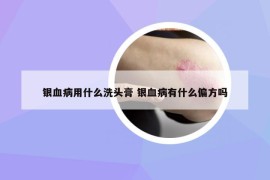 银血病用什么洗头膏 银血病有什么偏方吗