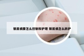 银屑病要怎么控制和护理 银屑病怎么防护
