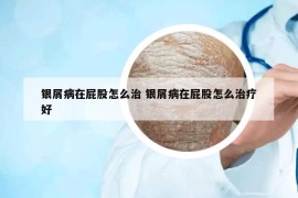 银屑病在屁股怎么治 银屑病在屁股怎么治疗好