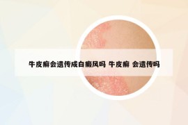 牛皮癣会遗传成白癜风吗 牛皮癣 会遗传吗