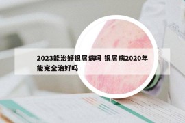 2023能治好银屑病吗 银屑病2020年能完全治好吗