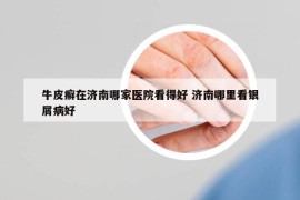 牛皮癣在济南哪家医院看得好 济南哪里看银屑病好