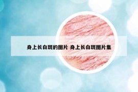 身上长白斑的图片 身上长白斑图片集