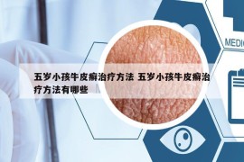 五岁小孩牛皮癣治疗方法 五岁小孩牛皮癣治疗方法有哪些