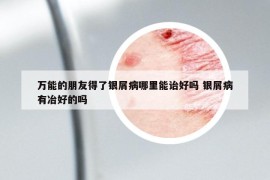 万能的朋友得了银屑病哪里能诒好吗 银屑病有冶好的吗