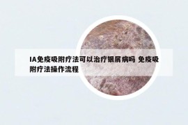 IA免疫吸附疗法可以治疗银屑病吗 免疫吸附疗法操作流程