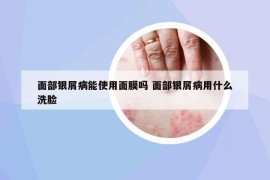 面部银屑病能使用面膜吗 面部银屑病用什么洗脸