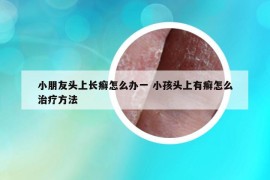 小朋友头上长癣怎么办一 小孩头上有癣怎么治疗方法