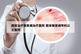 西安治疗银屑病治疗医院 西安银屑病专科公立医院