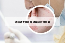 酒精诱发银屑病 酒精治疗银屑病