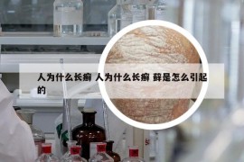 人为什么长癣 人为什么长癣 藓是怎么引起的