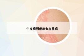 牛皮癣到老年会加重吗