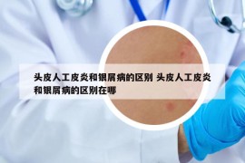 头皮人工皮炎和银屑病的区别 头皮人工皮炎和银屑病的区别在哪
